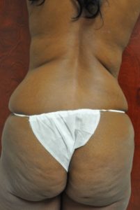 Laser Lipo with Smart Lipo Before and After Pictures Near Annapolis, Baltimore, and Washington, DC