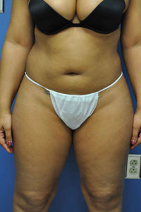 Laser Lipo with Smart Lipo Before and After Pictures Near Annapolis, Baltimore, and Washington, DC