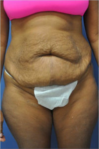 Tummy Tuck Before and After Pictures Near Annapolis, Baltimore, and Washington, DC