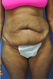 Mini Tummy Tuck Before and After Pictures Near Annapolis, Baltimore, and Washington, DC