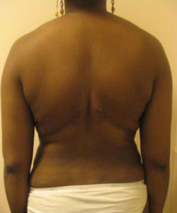 Body Lift Before and After Pictures Near Annapolis, Baltimore, and Washington, DC