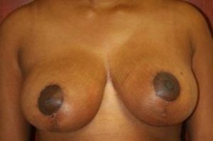Breast Reduction Before and After Pictures Near Annapolis, Baltimore, and Washington, DC