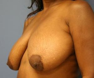 Breast Lift Before and After Pictures Near Annapolis, Baltimore, and Washington, DC