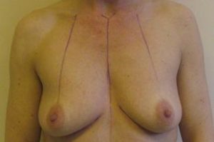 Breast Augmentation Before and After Pictures Near Annapolis, Baltimore, and Washington, DC