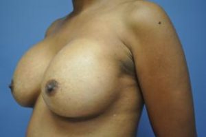 Breast Augmentation Before and After Pictures Near Annapolis, Baltimore, and Washington, DC