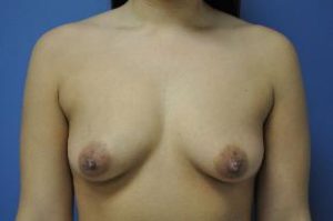 Breast Augmentation Near Annapolis, Baltimore, and Washington, DC