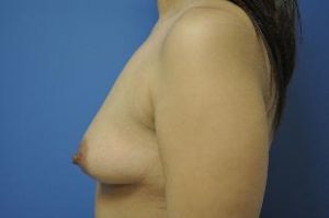 Breast Augmentation Near Annapolis, Baltimore, and Washington, DC