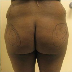 Brazilian Butt Lift Before and After Pictures Near Annapolis, Baltimore, and Washington, DC