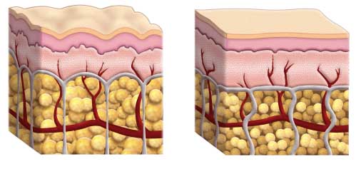Whtas Cellulite What is Cellulite? - Beaux Arts