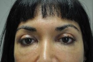 Blepharoplasty Before and After Pictures Near Annapolis, Baltimore, and Washington, DC