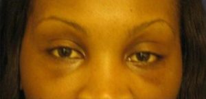 Blepharoplasty Before and After Pictures Near Annapolis, Baltimore, and Washington, DC