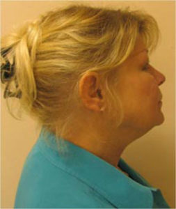 Facelift Before and After Pictures Near Annapolis, Baltimore, and Washington, DC