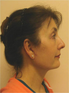 Facelift Before and After Pictures Near Annapolis, Baltimore, and Washington, DC