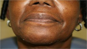 Lip Augmentation Before and After Pictures Near Annapolis, Baltimore, and Washington, DC