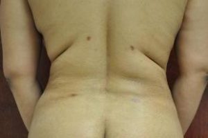 Liposuction Near Annapolis, Baltimore, and Washington, DC