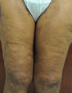 Thigh Lift Before and After Pictures Near Annapolis, Baltimore, and Washington, DC