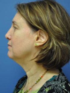 Neck Lift Before and After Pictures Near Annapolis, Baltimore, and Washington, DC
