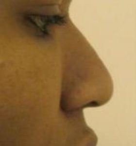 Rhinoplasty Before and After Pictures Near Annapolis, Baltimore, and Washington, DC