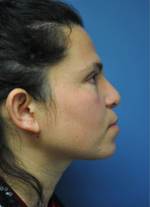 Rhinoplasty Before and After Pictures Near Annapolis, Baltimore, and Washington, DC