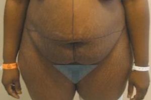 Tummy Tuck (Abdominoplasty) Near Annapolis, Baltimore, and Washington, DC