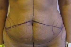 Tummy Tuck Before and After Pictures Near Annapolis, Baltimore, and Washington, DC
