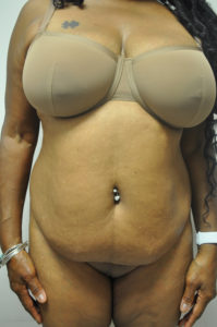 Liposuction Before and After Pictures Near Annapolis, Baltimore, and Washington, DC