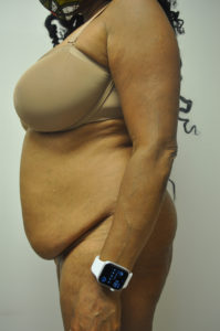 Liposuction Before and After Pictures Near Annapolis, Baltimore, and Washington, DC