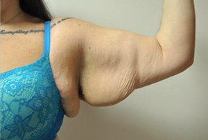 Brachioplasty Before and After Pictures Near Annapolis, Baltimore, and Washington, DC